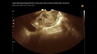 Ultrasound ovarian tumor [upl. by Orren429]