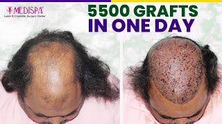 5500 Grafts Hair Transplant in Grade 6 Baldness in single sitting drsuneetsoni1 [upl. by Pontias]