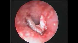 Fruitfly Larva in the Auditory Canal  NEJM [upl. by Winter877]