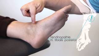 Tendinopathie m tibialis posterior [upl. by Nodnyl142]