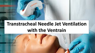 Transtracheal Needle Jet Ventilation TTJV with the Ventrain [upl. by Egroej]