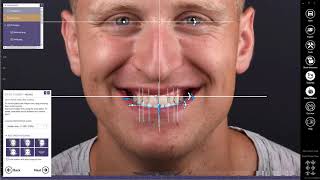 exocad Smile Creator Now Integrated with Carestream Dentals CS 3600 and CS 3700 Intraoral Scanners [upl. by Ransell]