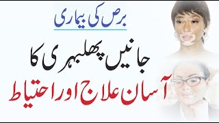 What Is Vitiligo  How To Treat Vitiligo پھلبہری کا علاج  QAS Health [upl. by Faxan]