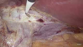 Laparoscopic cholecystectomy unedited 1982024 [upl. by Nuyh537]