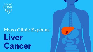 Mayo Clinic Explains Liver Cancer [upl. by Ydnagrub29]