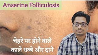 चेहरे पर होने वाले काले धब्बे और दाने  Anserine Folliculosis Keratosis Pilaris Black Spots on Face [upl. by Asssilem584]