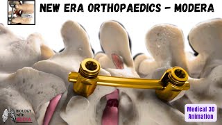 New Era Orthopaedics Modera  Medical Animation 3D Video  BiologywithAliya [upl. by Ecneralc]