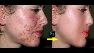 Retouching Skin  Professional Advanced Photo Retouching Photoshop Tutorial [upl. by Aigroeg546]