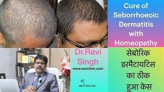 Seborrheic Dermatitis Homoeopathic Cure DrRavi Singh [upl. by Eimile]