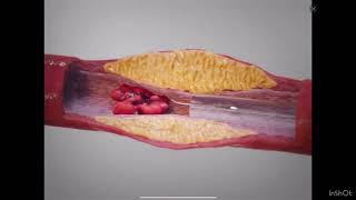 Atherosclerosis Procedure Medicalschooleasylearning [upl. by Nilson134]