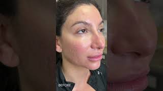 THE PROCESS OF ACNE SCAR COMBINATION TREATMENTS FOR SENSITIVE SKIN TYPES  Dr Jason Emer [upl. by Adelice]