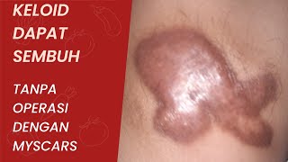 KELOID SEMBUH DENGAN MYSCARS Minggu Pertama [upl. by Akeylah]