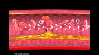 Atherosclerosis and thrombus formation  Heart [upl. by Koblick]