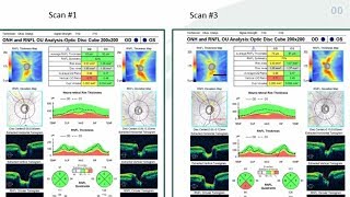 10 Hacks for OCT Interpretation in Glaucoma  Dr Mark Dunbar [upl. by Yenreit969]