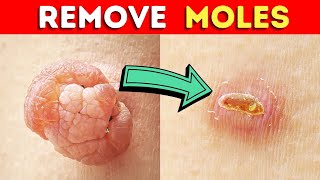 How to Remove a Mole Quickly With Castor Oil [upl. by Adien]