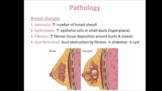 Fibroadenosis [upl. by Haldes717]