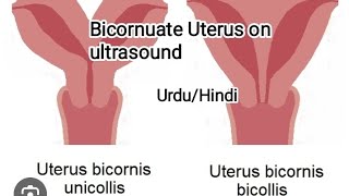 Pelvic UltrasoundBicornuate uterusseptate unterus [upl. by Llerrah]