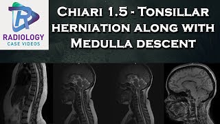 Chiari 15  Tonsillar herniation along with Medulla descent [upl. by Akemet456]