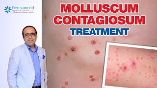 Molluscum Contagiosum Treatment  Dr Rohit Batra [upl. by Cioban]