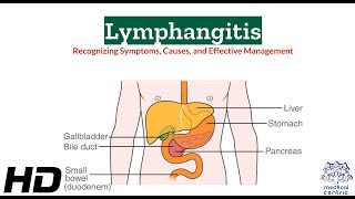 Lymphangitis 101 A Comprehensive Guide to Symptoms and Effects [upl. by Yhtak]