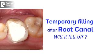 How long can you keep a temporary filling after root canal  Dr Chandan Mahesh [upl. by Waddell]