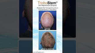 How Hair Transplant Results can be Further Improved Without Surgery hairtransplant [upl. by Anaerol]