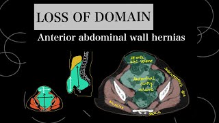 LOSS OF DOMAIN CALCULATION for abdominal wall hernias on CT scan SABBAGH and TANAKA methods [upl. by Trebma]