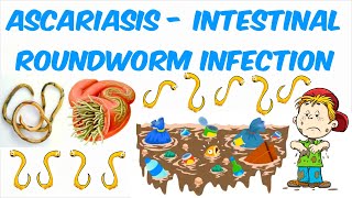 Ascariasis The Intestinal Roundworm Infection with Ascaris lumbricoides [upl. by Ivanah]