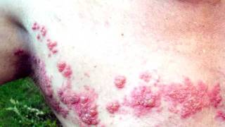 I Have Shingles  5 things you can do to combat Herpes Zoster shingles virus [upl. by Boyden809]