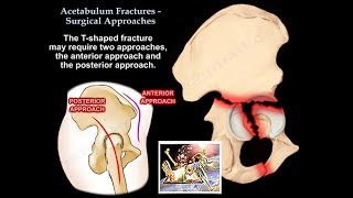 Acetabulum Fractures Surgical Approaches  Everything You Need To Know  Dr Nabil Ebraheim [upl. by Lehman]