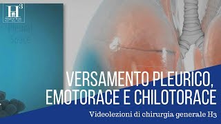 Versamento pleurico emotorace chilotorace [upl. by Devad717]