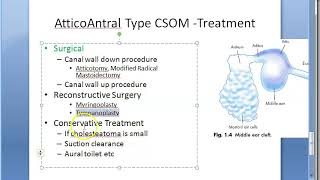 ENT AtticoAntral CSOM Treatment [upl. by Notyrb]