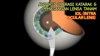 Operasi Bedah Katarak Dalam Animasi dan Pemasangan IOL  Intra Ocular Lens [upl. by Borek34]