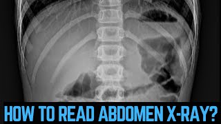 पेट का एक्सरे कैसे देखते हैं How to read abdomen xray petkaxraykaisehotahai abdominalxray xray [upl. by Klenk]