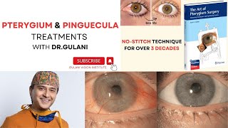 Pinguecula Treatments and Pterygium Treatments GulaniVision [upl. by Wittenburg]