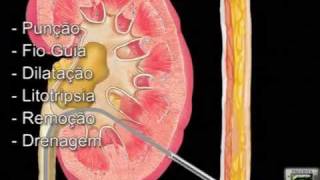 Técnica de Cirurgia Renal Percutânea [upl. by Lavro991]