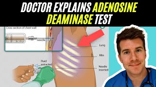 Doctor explains Adenosine Deaminase test  Tuberculosis TB [upl. by Ardnalahs]