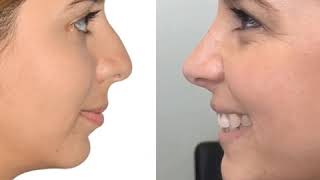 Thick Skin Rhinoplasty  Andres Bustillo MD [upl. by Slaughter]