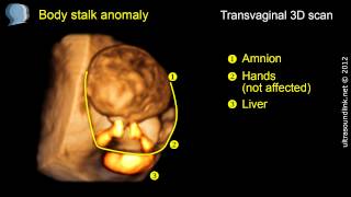 Body stalk anomaly limbbody wall complex [upl. by Kcirded]