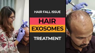 Exosomes Treatment for Hair Fall Issue  HASH CLINICS [upl. by Rashidi]