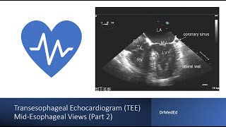 Transesophageal Echocardiogram TEE  Mid Esophageal Views [upl. by Yelda616]