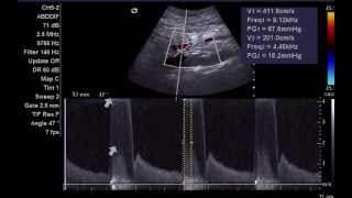 Mesenteric Artery stenosis [upl. by Argent]