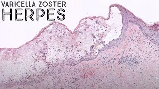 Shingles under the microscope Varicella Zoster Herpes virus Chickenpox VZV pathology dermatology [upl. by Lalib]