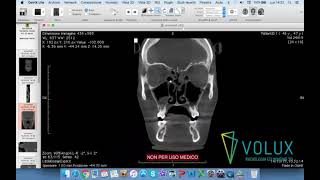 Volux  Tutorial OsiriX Lite parte 1 di 2 [upl. by Valentino]