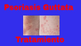 ✅Psoriasis Guttata Tipos de Tratamiento de la Psoriasis Guttata PSORIASIS EN GOTAS [upl. by Granlund]