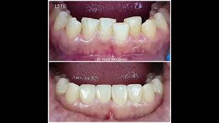 Smile makeover by Dr Majd Mouawad few clinical cases [upl. by Yazbak]