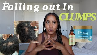 Is THIS why my hair is FALLING OUT IN CLUMPS Surviving Mielle Organics [upl. by Eila]