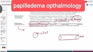 papilledema ophthalmology 20  First Aid USMLE Step 1 in UrduHindi [upl. by Anayeek]