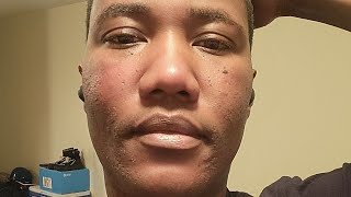 Banish Skin Care  Banisher 30 progress are my scars getting better [upl. by Bachman307]