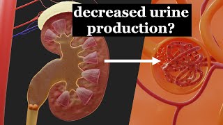 Reduced urine production due to a kidney stone [upl. by Kra]